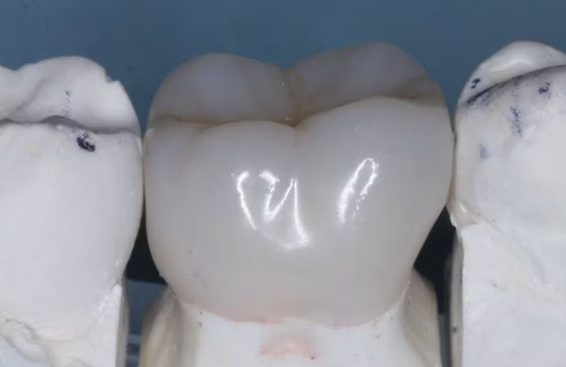 In 3D răng sứ đang phát triển mạnh: Liệu công nghệ này có phù hợp với phòng khám của bạn?